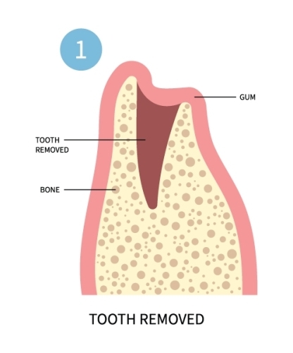 Oral Surgery Instructions | Oral Surgeons in Birmingham - ImplantsGrafting1