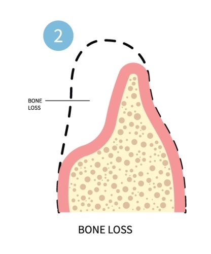 Oral Surgery Instructions | Oral Surgeons in Birmingham - ImplantsGrafting2