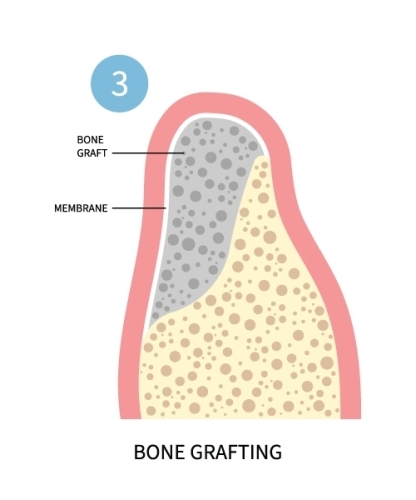 Oral Surgery Instructions | Oral Surgeons in Birmingham - ImplantsGrafting3