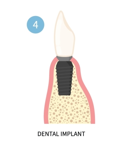 Oral Surgery Instructions | Best Oral Surgeons in Birmingham, AL - ImplantsGrafting4