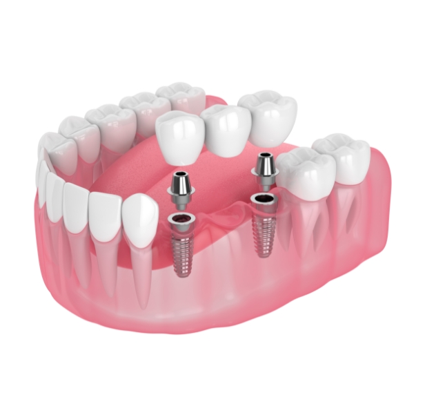 Your Trusted Dental Implant Experts in Birmingham, AL | Maniscalco - GCM10