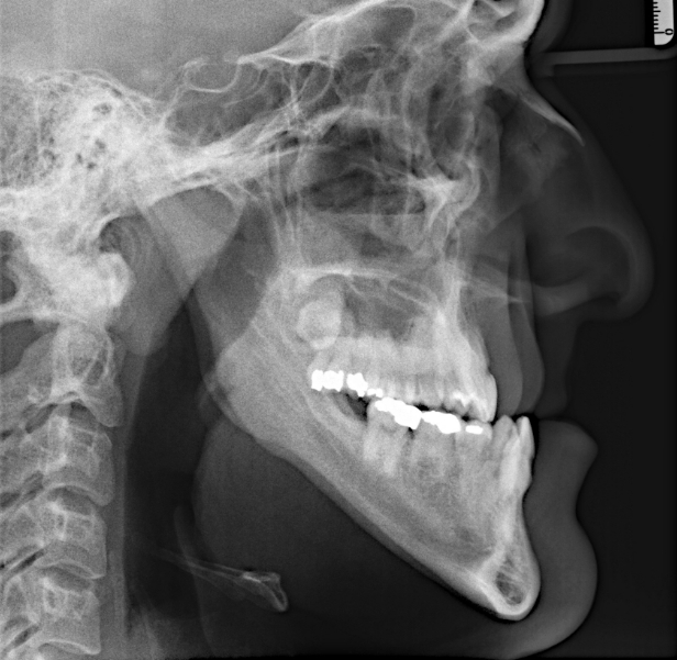 Jaw Surgery | TMJ Treatment in Birmingham, AL - GCM7