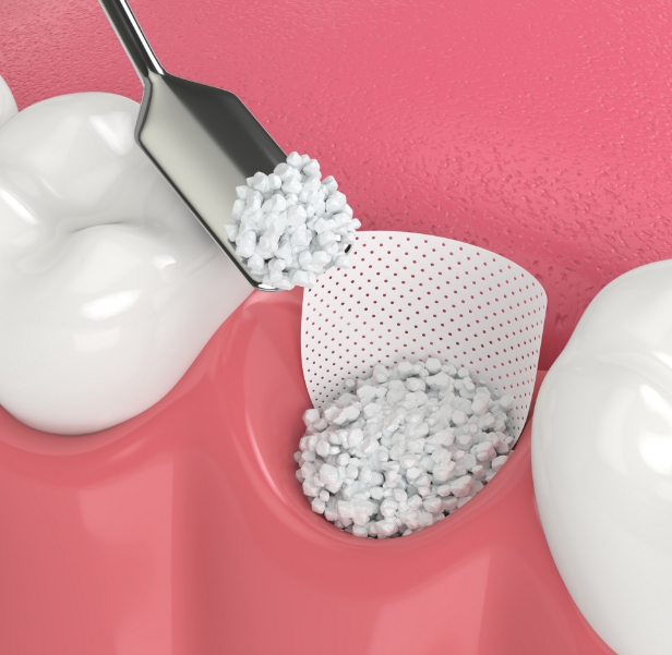 Quality Bone Grafting for Dental Implants | Birmingham | Maniscalco - GCM9